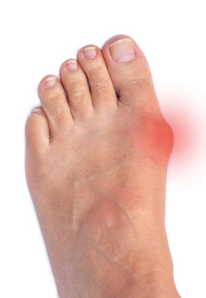 Foot Bunion